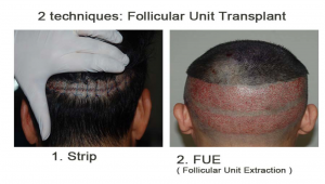 Hair Transplant Manila Philippines | Hair Transplant Manila Philippines |