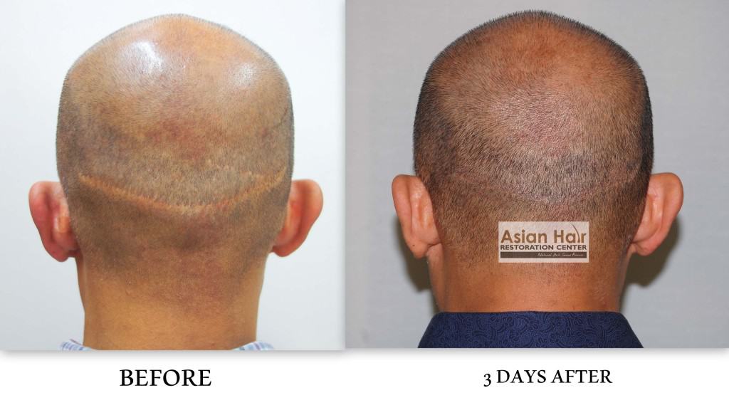 Scalp Micropigmentation - Scar Camouflage  sain Hair Restoration Center