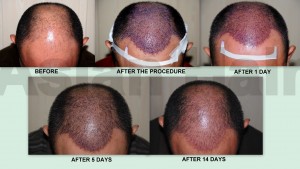 Recipient Area Healing Stages 14 days after the procedure