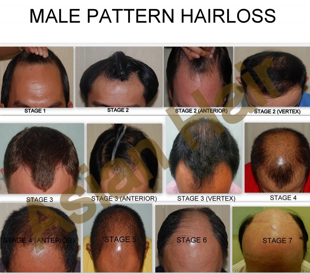 Male Pattern Baldness|Asian Hair Restoration Center