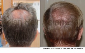  Strip FUT before and after results | Asian Hair Restoration Center