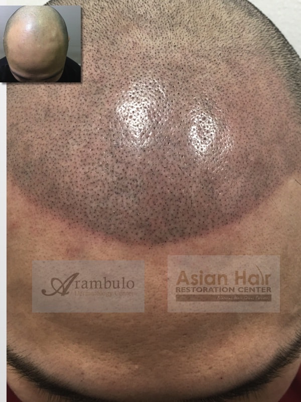 SMP before and after photos |Asian Hair Restoration Center