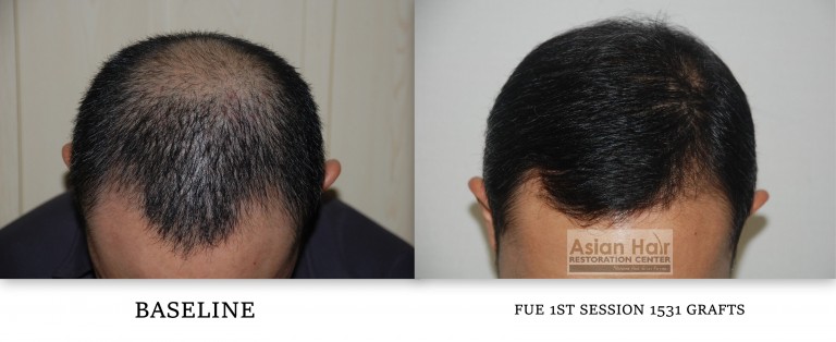 FUE Philippines |Asian Hair Restoration Center