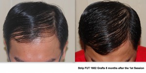 Hairline restoration Philippines |Asian Hair Restoration Center