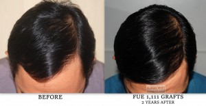 Hair loss treatment |Asian Hair Restoration Center