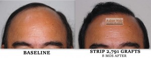 STRIP before and After Photos Philippines |Asian Hair Restoration Center