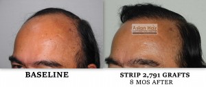 Strip Surgery Results |Asian Hair Restoration Center