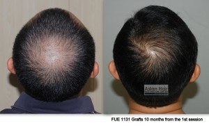 Crown Hair Transplant Result Philippines | Asian Hair Restoration Center