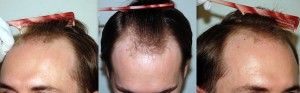  Dwaine Woolley before hair transplant | Asian Hair Restoration Center