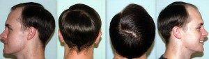Dwaine Woolley Baseline | Asian Hair Restoration Center