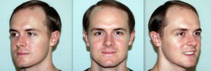  Dwaine Woolley  baseline |Asian Hair Restoration Center