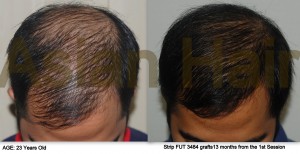 Hair Transplant Before and After |Asian Hair Restoration Center
