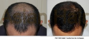 FUE Philippines |Asian Hair Restoration Center