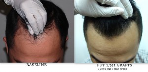 Hair Transplant  Results by FUE technique |Asian Hair Restoration Center