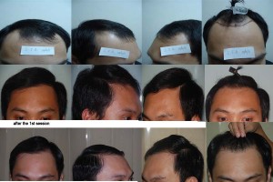 Hair Transplant Patient Testimonial - Before and After hair transplant Results |Asian Hair Restoration Center
