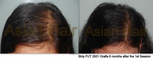 Strip hair transplant before and after results in female |Asian Hair Restoration Center