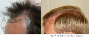 Hair Transplant Patient  Testimonial | Strip Hair Transplant |Asian Hair Restoration Center
