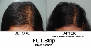 Female Pattern Baldness | Asian Hair Restoration Center