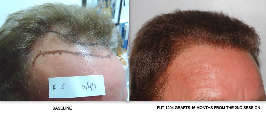 Strip Surgery result Philippines |Asian Hair Restoration Center