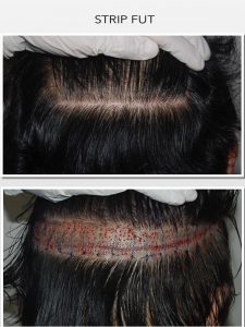 STRIP after hair transplant