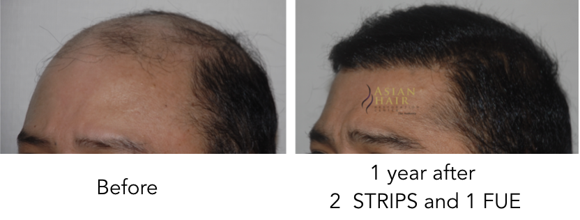 Hair Transplant at Asian Hair Restoration Center