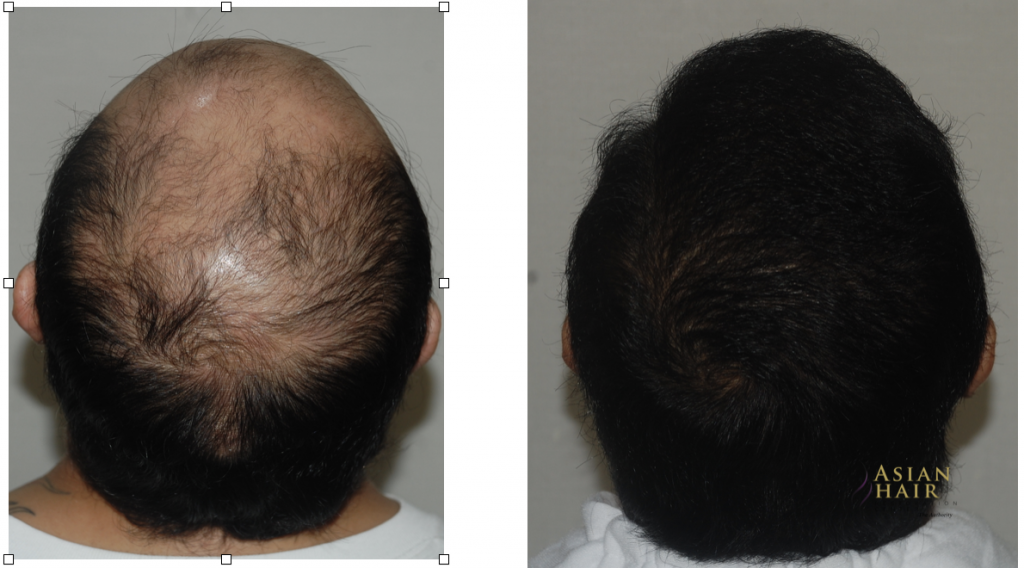 Crown hair transplant before and after |Dr. Julieta Peralta Arambulo