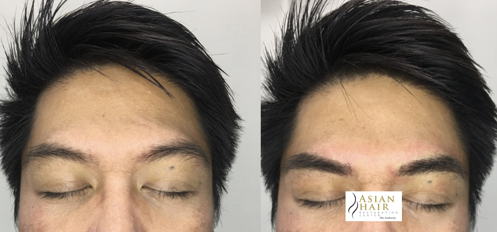 Eyebrow Microblading Results in Male in the Philippines | Asian Hair Restoration Center