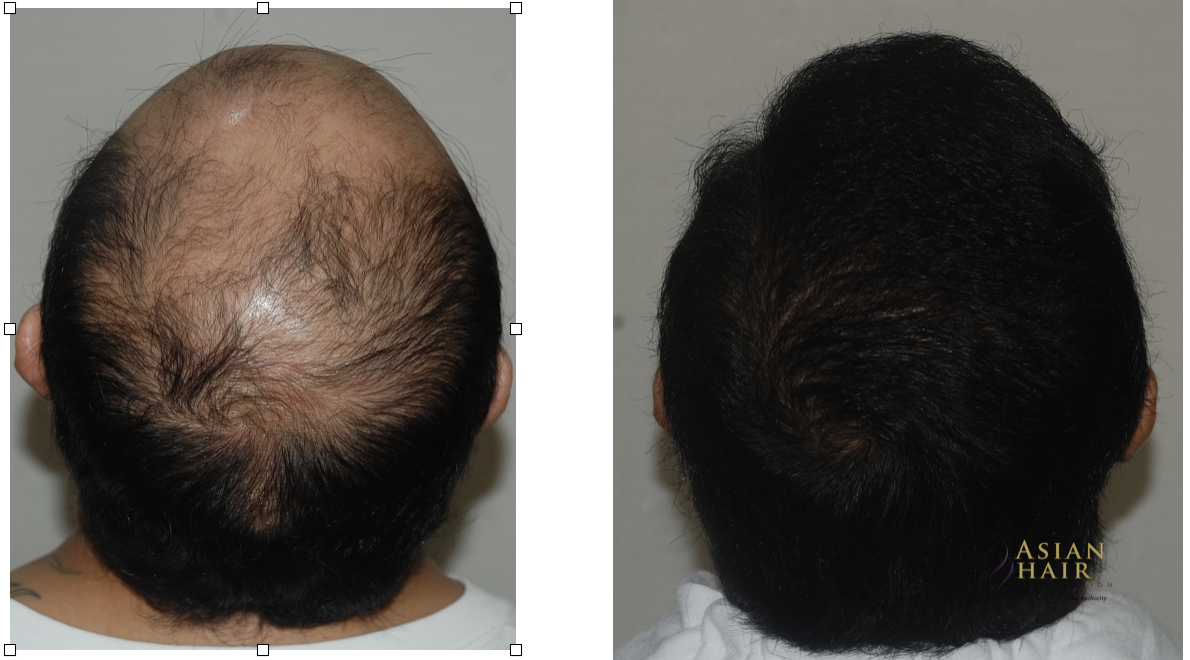 Hair Transplant before and After for Androgenic Alopecia 