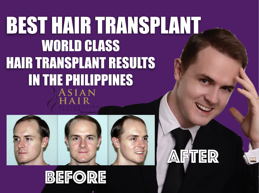 FUE Before and After Photos | Dwaine Woolley
