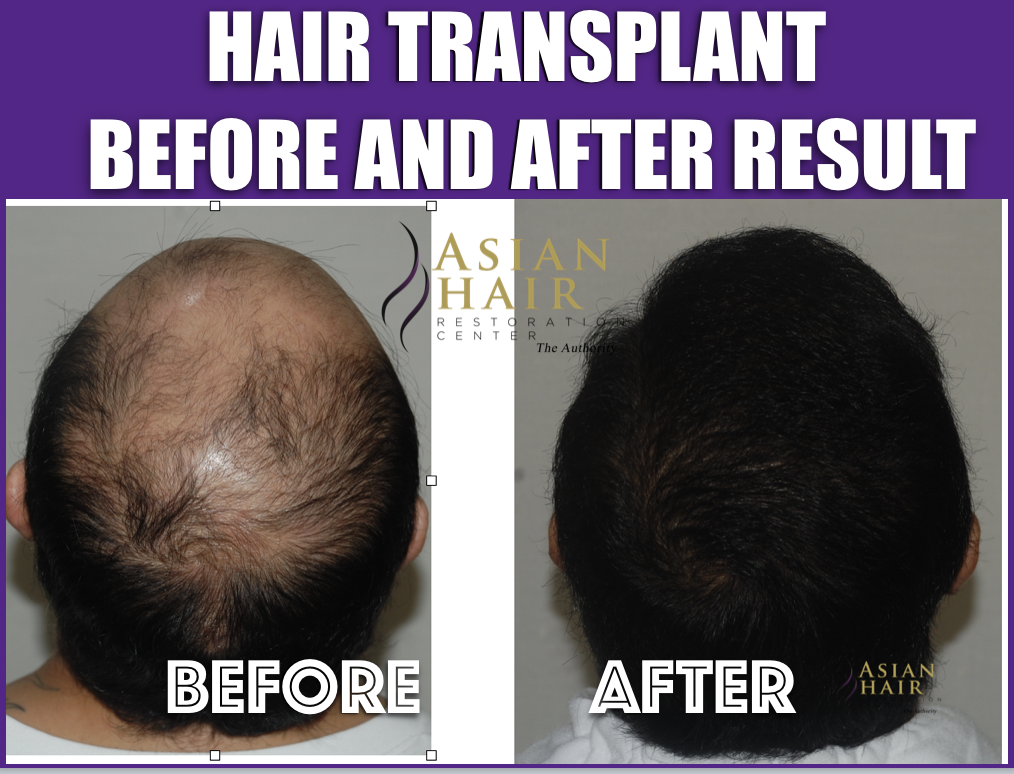 Hair Transplant Results | Crown | Philippines