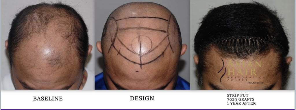 Hair Transplant Manila Philippines | Hair Transplant Manila Philippines |