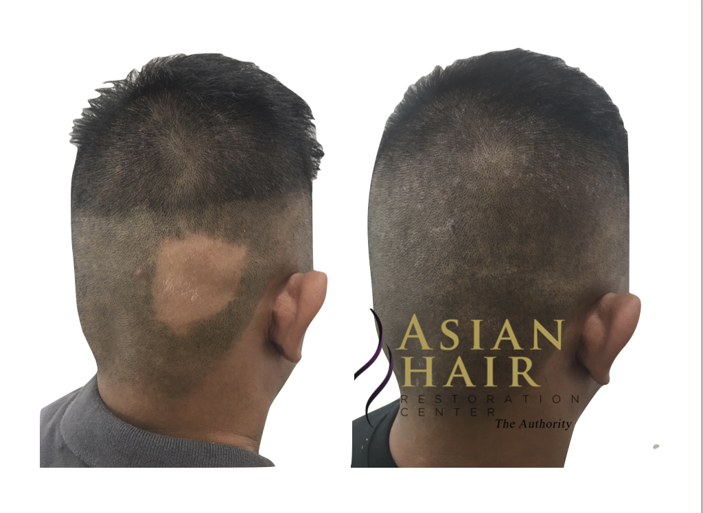SMP in Alopecia Areata |Asian Hair Restoration Center