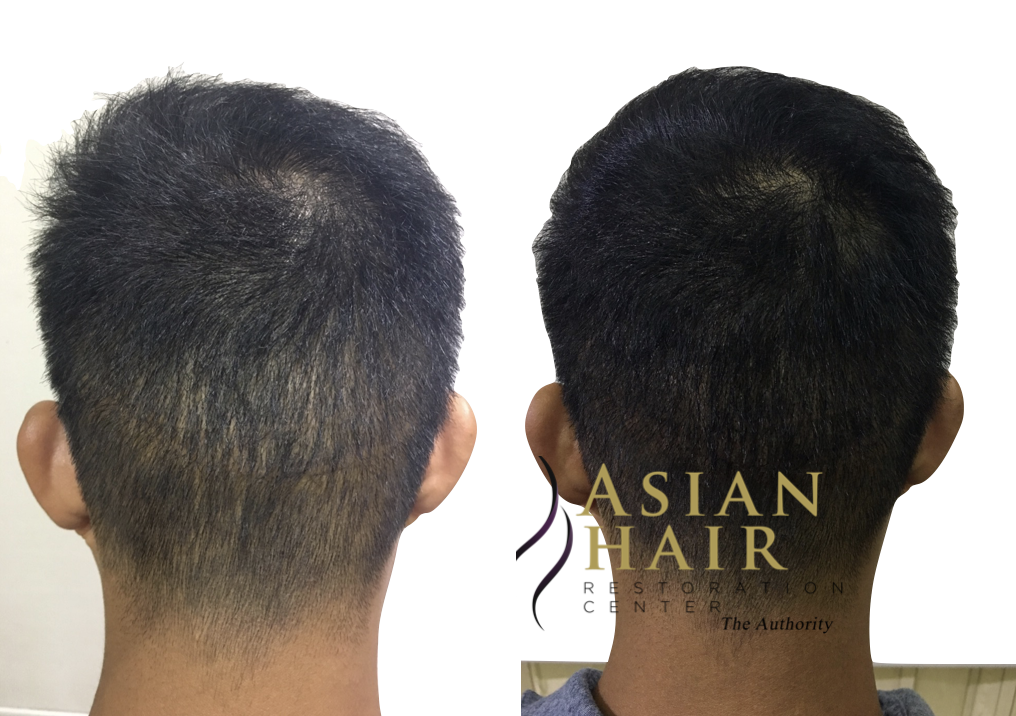 SMP for scalp scars