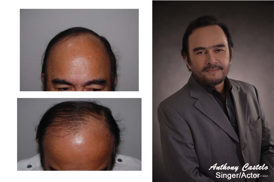 Hair transplant Results |Before and After Photos |Asian Hair Restoration CenterPhilippines