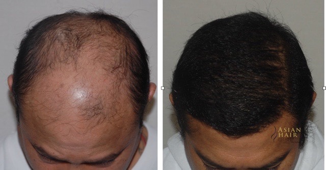 Hair Transplant Results Philippines | Dr. Julieta Peralta Arambulo