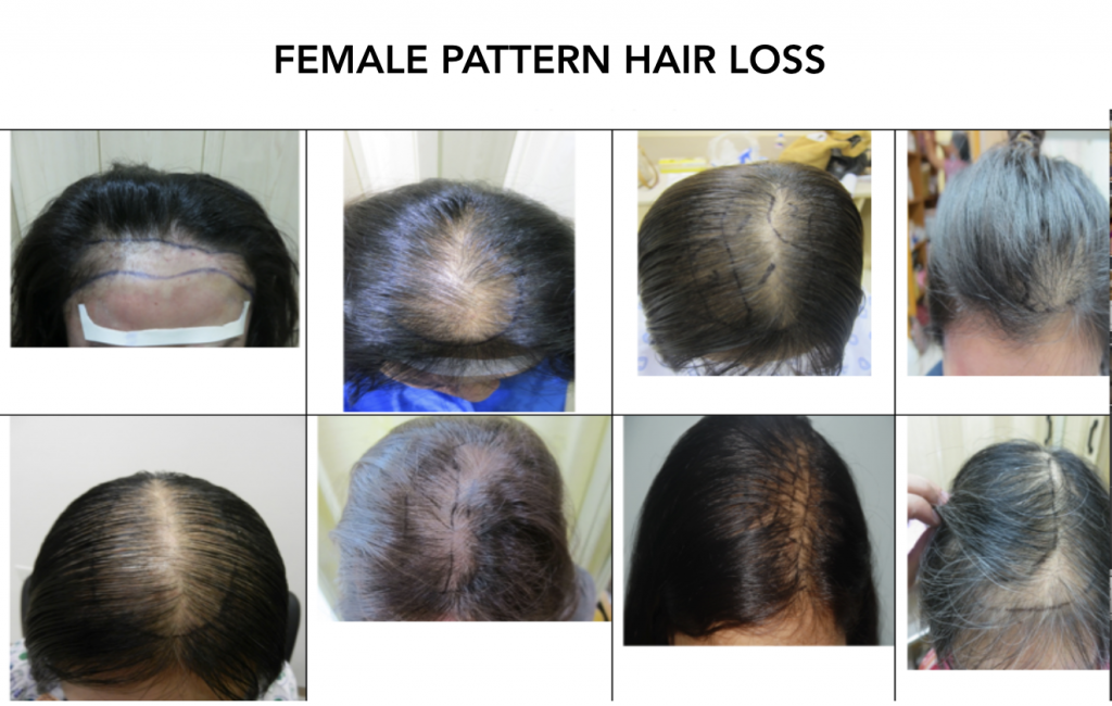 Female pattern hair loss