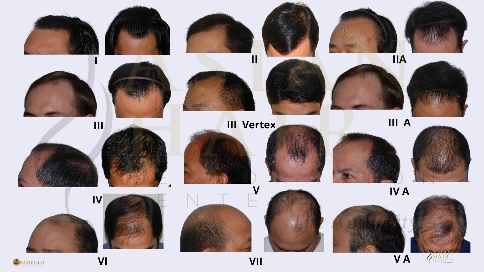 Male Androgenetic Alopecia  Endotext  NCBI Bookshelf