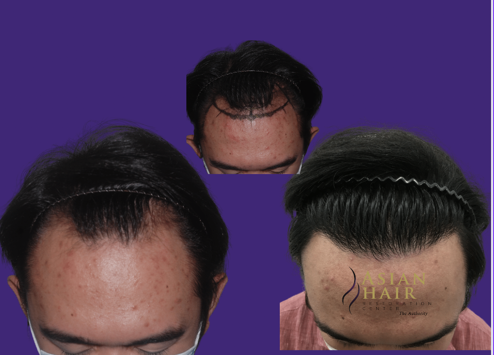 hairline restoration in the Philippines