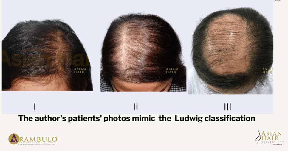 Hair Transplant in Female Sucess in Female Pattern Hair Loss