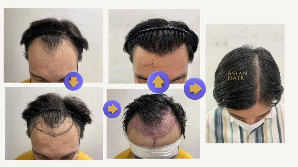 Hair Transplant Success Rate 