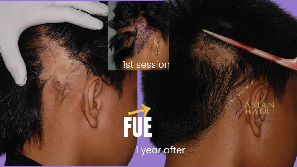 hair transplant in scar tissue 